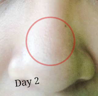 Derma Angel Acne Patch